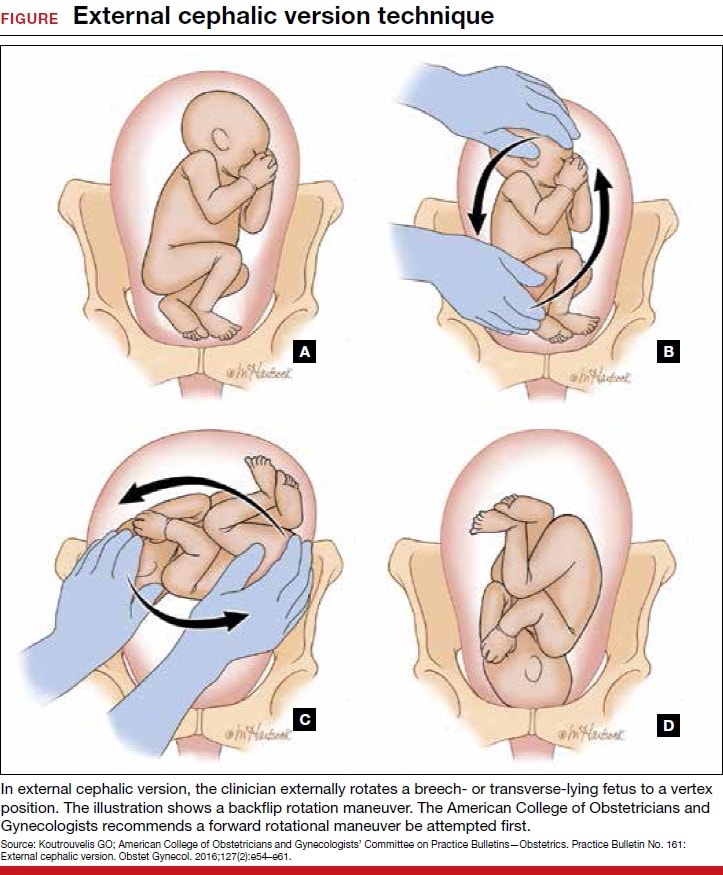 how to perform an external cephalic version